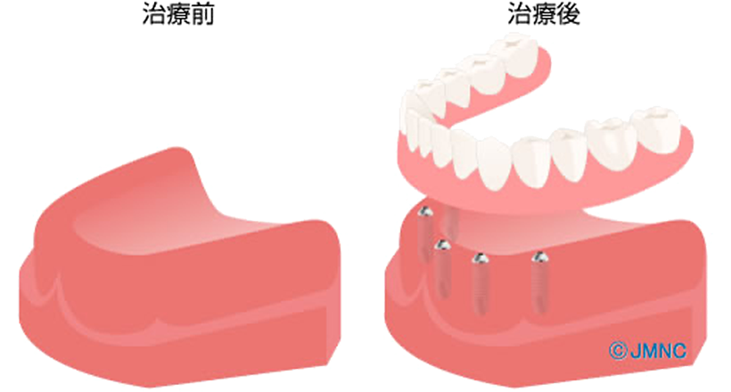 歯を何本か失った場合