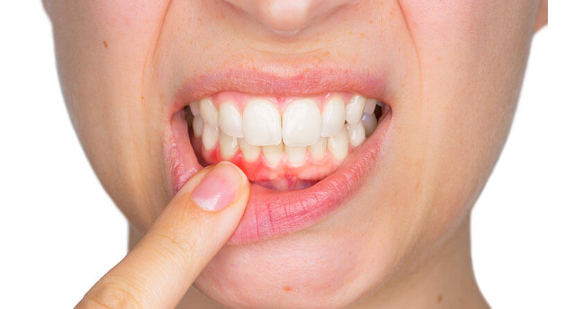 歯肉の形や黒ずみを改善