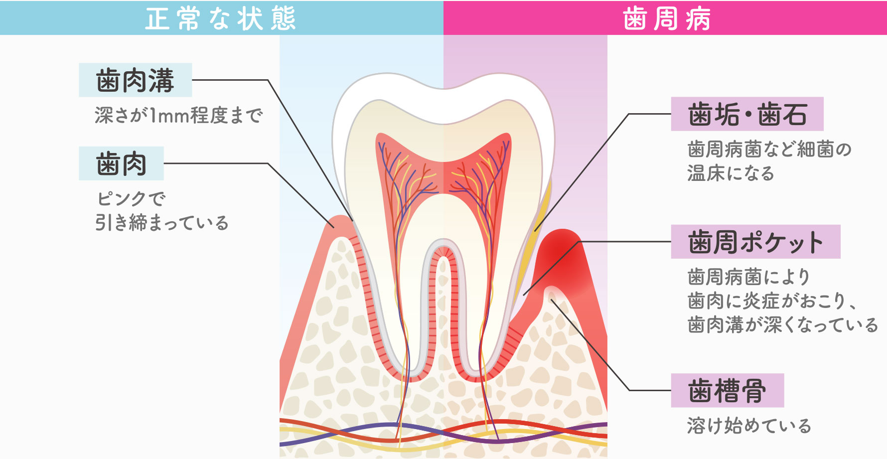 歯周病治療