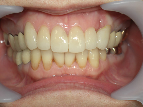 歯の位置と色が気になる症例　施術後