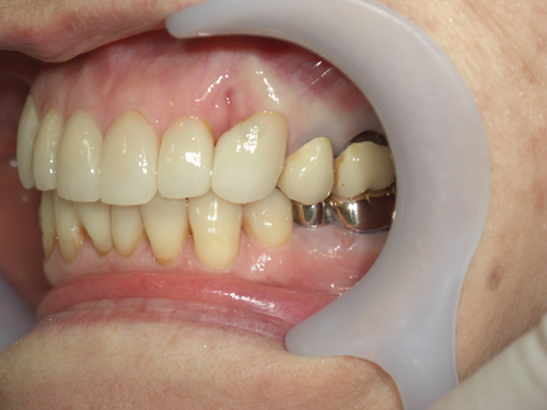 歯の位置と色が気になる症例2　術後
