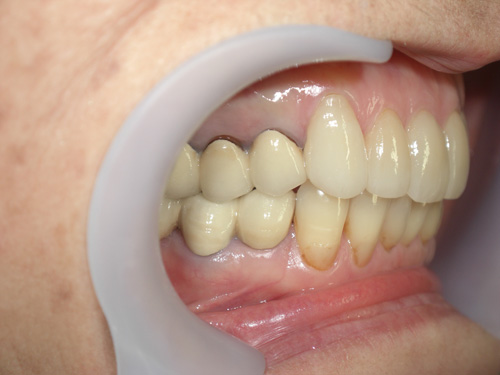 歯の位置と色が気になる症例3　術後