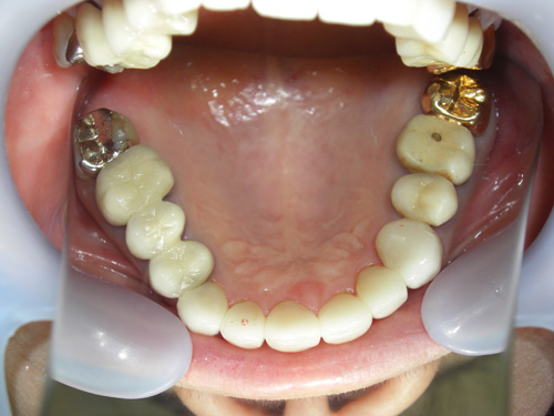 歯の位置と色が気になる症例4　術後