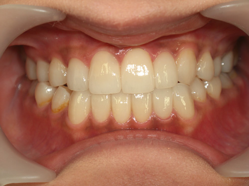前歯の歯並びが気になる症例　施術後