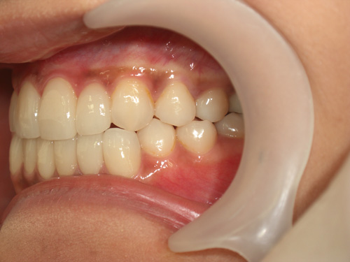 前歯の歯並びが気になる症例2　術後