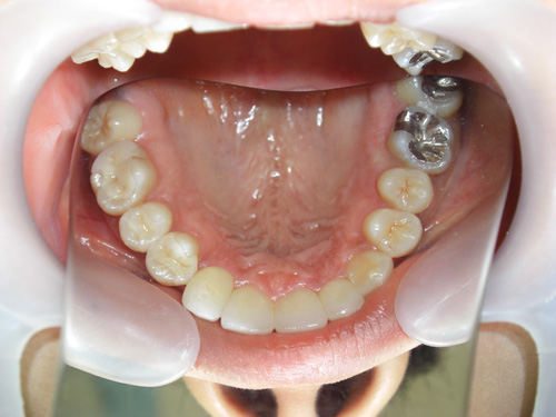 前歯の歯並びが気になる症例4　術後