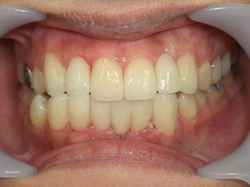 前歯の歯並びと歯肉の位置がまちまちなのが気になる症例　施術後