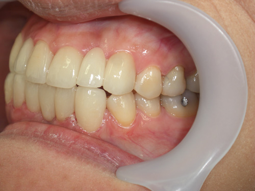 前歯の歯並びと歯肉の位置がまちまちなのが気になる症例2　術後