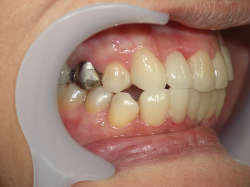 前歯の歯並びと歯肉の位置がまちまちなのが気になる症例3　術後
