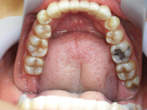 前歯の歯並びと歯肉の位置がまちまちなのが気になる症例4　術後