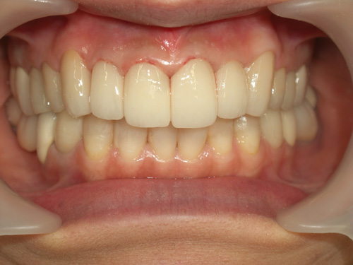 前歯の歯肉の色と隙間が気になる症例 施術後