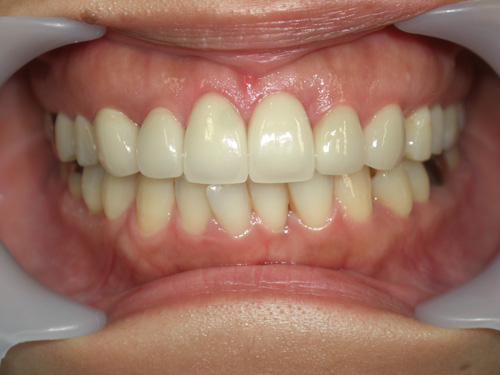 歯の位置のねじれと隙間が気になる症例　施術後