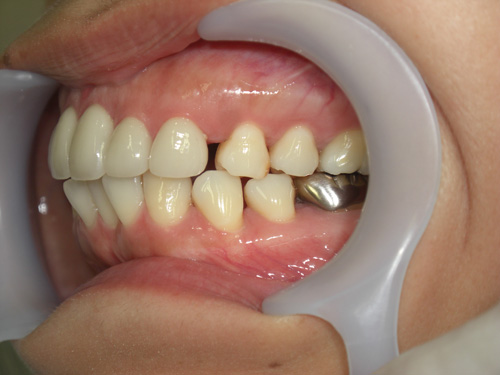歯の位置のねじれと隙間が気になる症例2　術後
