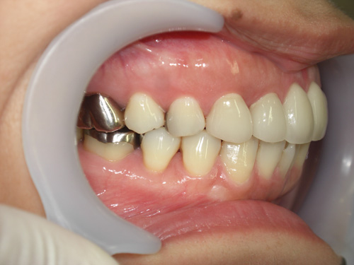 歯の位置のねじれと隙間が気になる症例3　術後