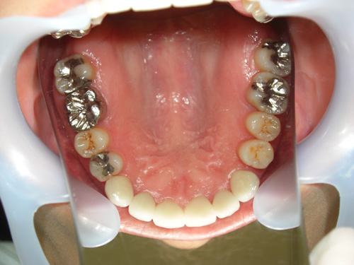 歯の位置のねじれと隙間が気になる症例4　術後