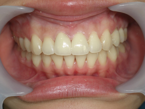 前歯2本の前突が気になる症例　施術後
