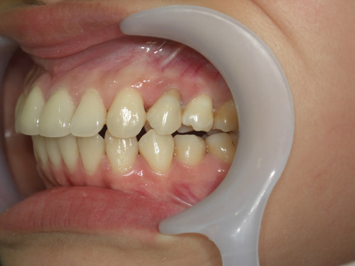 前歯2本の前突が気になる症例2　術後