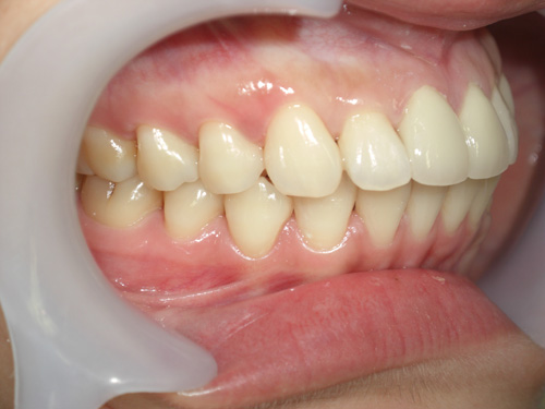 前歯2本の前突が気になる症例3　術後