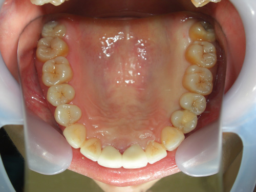 前歯2本の前突が気になる症例4　術後