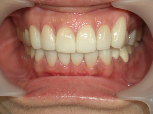 薬物により先天的に歯に色がついてしまった症例　施術後