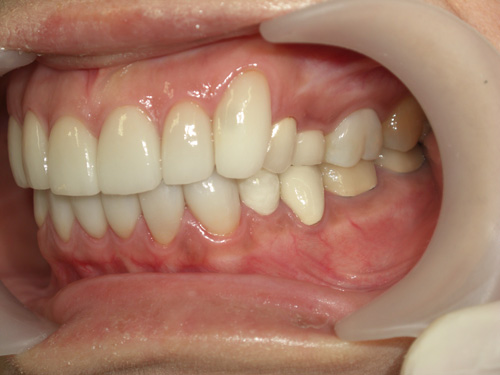薬物により先天的に歯に色がついてしまった症例2　術後