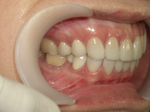 薬物により先天的に歯に色がついてしまった症例3　術後