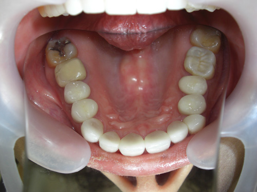 薬物により先天的に歯に色がついてしまった症例4　術後