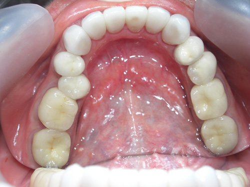 薬物により先天的に歯に色がついてしまった症例5　術後