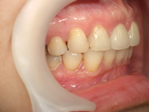 前歯がつぎはぎになっている症例　術後3