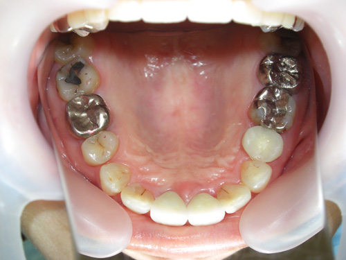 前歯がつぎはぎになっている症例　術後4