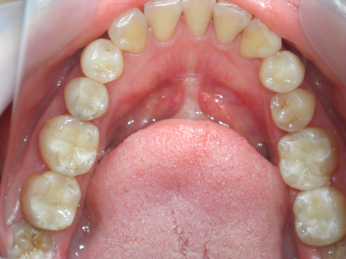 前歯がつぎはぎになっている症例　術後5