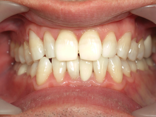 前歯の色を白くして金属の歯を白くした症例　施術後