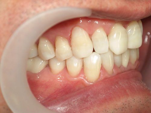 前歯の色を白くして金属の歯を白くした症例2　術後