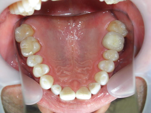 前歯の色を白くして金属の歯を白くした症例3　術後