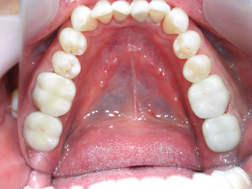 前歯の色を白くして金属の歯を白くした症例4　術後