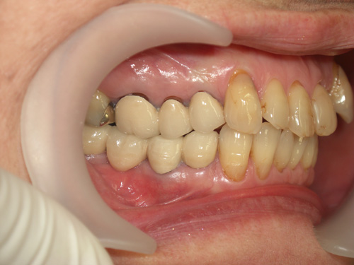 歯の位置と色が気になる症例3　術前