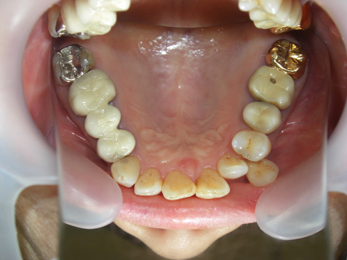 歯の位置と色が気になる症例4　術前
