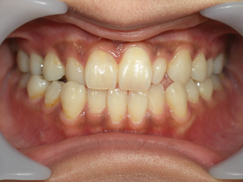 前歯の歯並びが気になる症例　術前