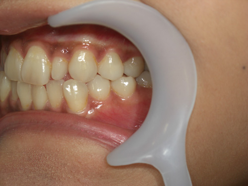 前歯の歯並びが気になる症例2　術前