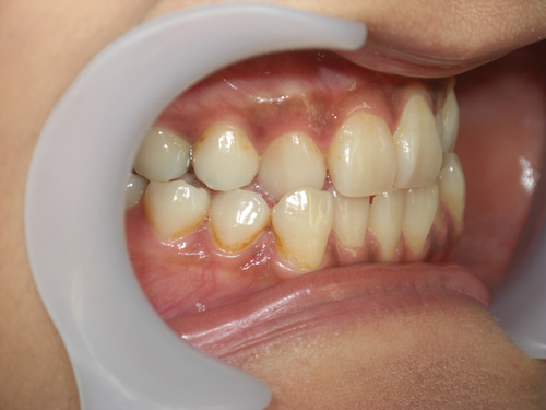 前歯の歯並びが気になる症例3　術前