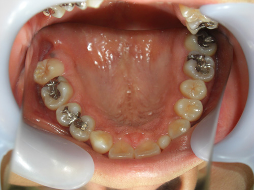 前歯の歯並びが気になる症例4　術前