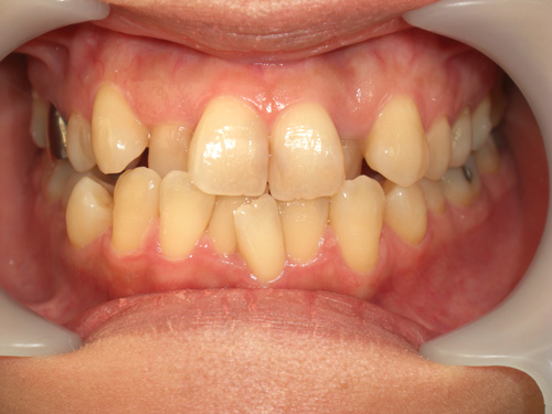 前歯の歯並びと歯肉の位置がまちまちなのが気になる症例　術前