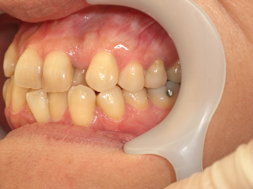 前歯の歯並びと歯肉の位置がまちまちなのが気になる症例2　術前