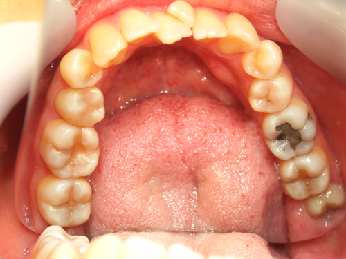 前歯の歯並びと歯肉の位置がまちまちなのが気になる症例4　術前