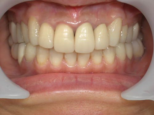 前歯の歯肉の色と隙間が気になる症例　術前