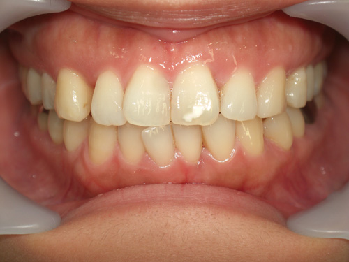 歯の位置のねじれと隙間が気になる症例　術前