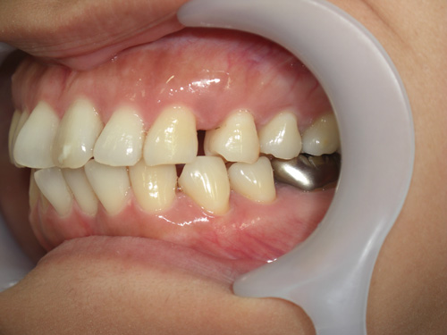 歯の位置のねじれと隙間が気になる症例2　術前