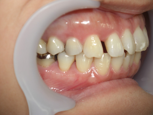 歯の位置のねじれと隙間が気になる症例3　術前