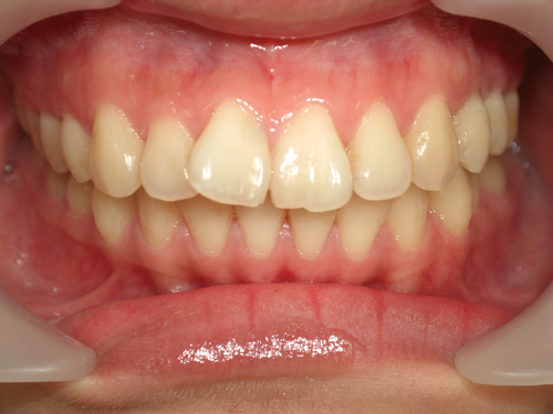 前歯2本の前突が気になる症例　術前