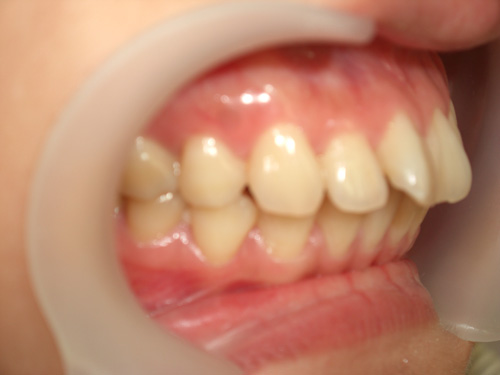 前歯2本の前突が気になる症例3　術前